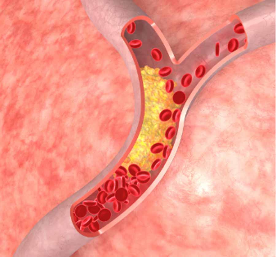 कोलेस्ट्रॉल को है ठीक से समझने की जरुरत