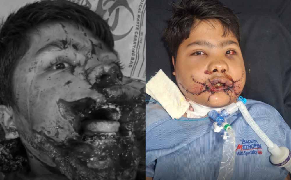 घर में बड़ा हादसा: फ्रिज ब्लास्ट से बच्चा बुरी तरह झुलसा, डॉक्टरों की टीम ने बचाई जान