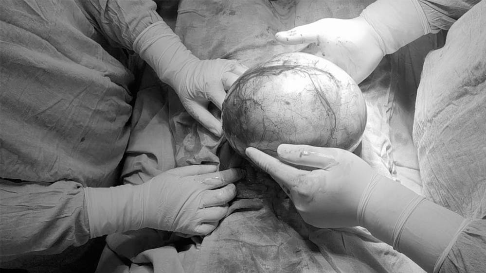 बुरहानपुर में मेडिकल टीम ने किया कमाल, महिला के पेट से निकाला विशाल 8 किलो ट्यूमर