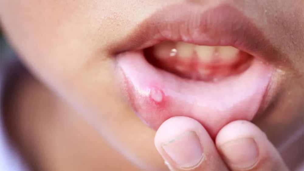 मुंह के छालों का घरेलू उपचार: दर्द और जलन से मिलेगी राहत