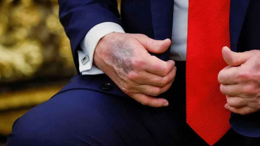 हाथ पर पड़े नीले दाग से मची हलचल, ट्रंप ने बताया सच या बढ़ी सस्पेंस की परत?