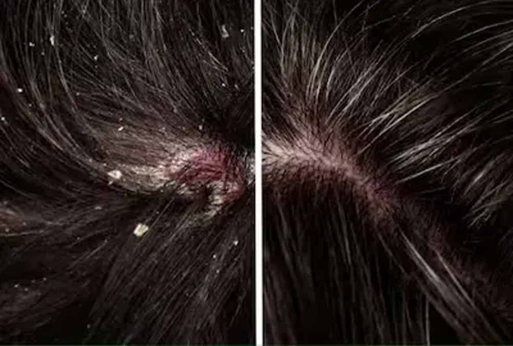 तेल लगाने से पहले रुकिए! डैंड्रफ समझकर स्कैल्प की इस समस्या को नज़रअंदाज़ न करें