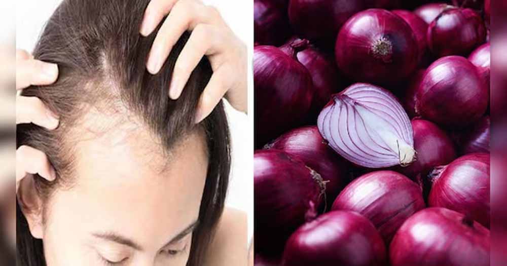 महंगे ट्रीटमेंट को कहें अलविदा, अपनाएं प्याज का तेल