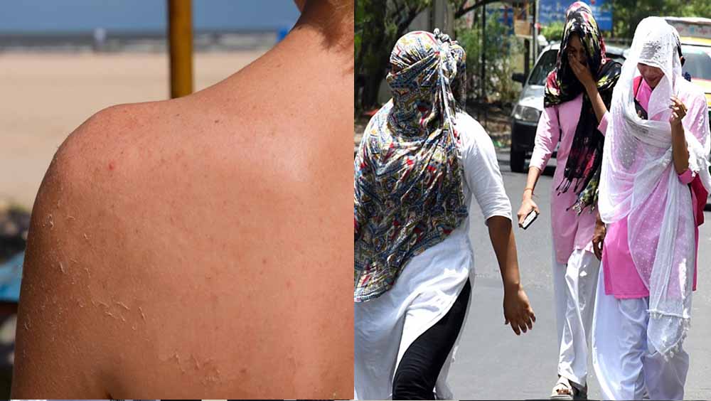 गर्मी बनी मुसीबत, त्वचा पर पड़ रहे धब्बे; अस्पतालों में बढ़े सनबर्न के मरीज